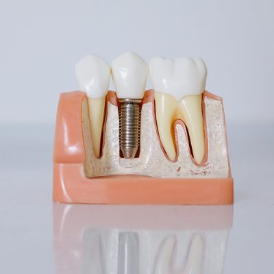 Dental Implant Cost