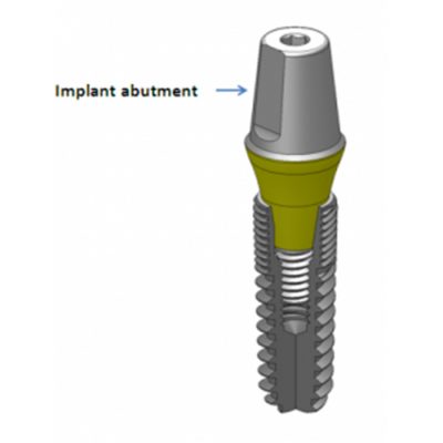 Implant Abutment